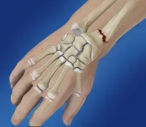 fracture du poignet