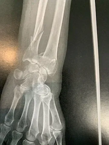 Une fracture de poignet