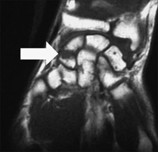 Fracture du scaphoïde à l'IRM