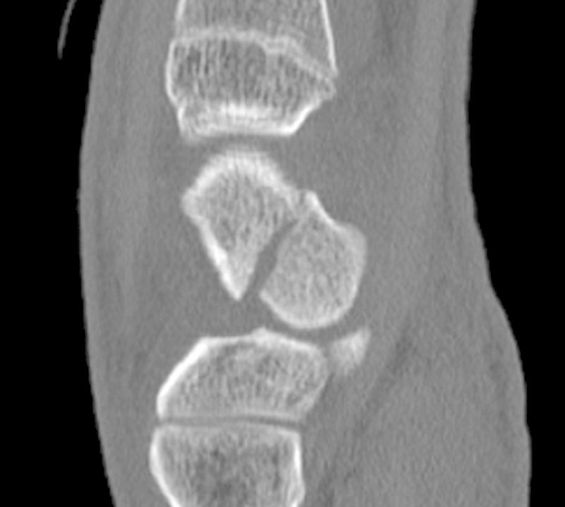 Fracture du scaphoïde vue au scanner